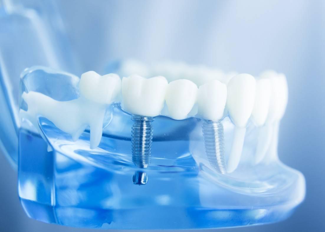 Dental Implants Winchester, VA